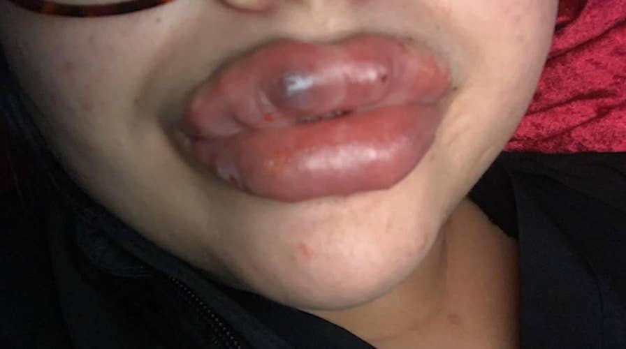 Several women claim botched lip injections caused severe infection