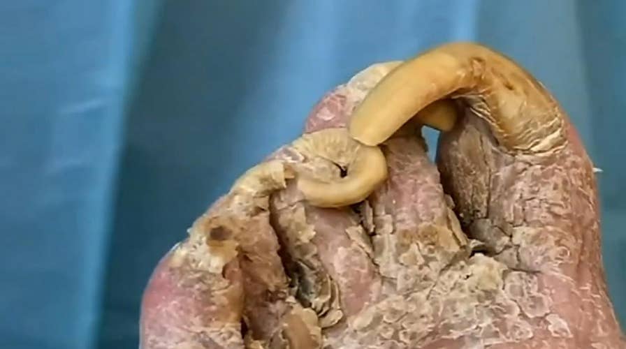 Florida podiatrist cuts patient’s giant infected toenails