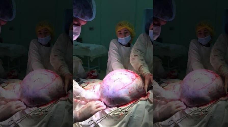 PICTURES: surgeons remove 55-pound tumor