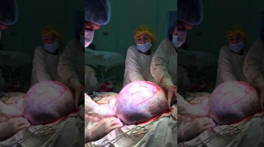 PICTURES: surgeons remove 55-pound tumor