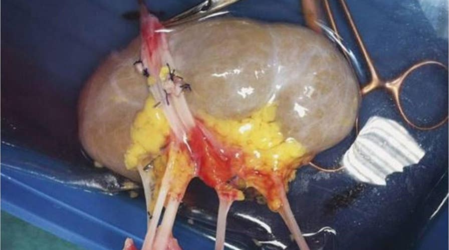 Kidney abnormality forces doctors to give 9-year-old’s kidney to another awaiting donor