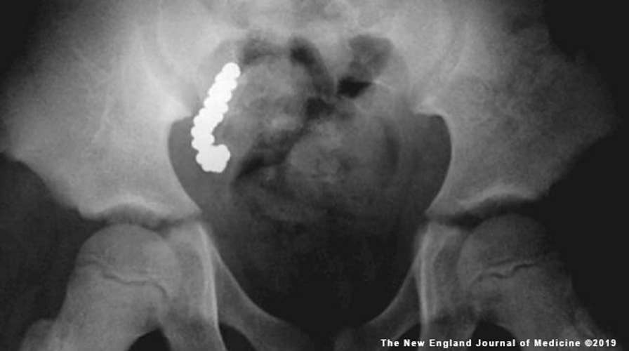 More than 50 lead pellets found in 8-year-old Australian boy’s appendix