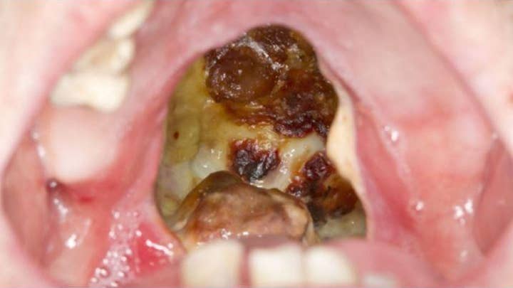 Cocaine abuse leaves fatal infected erosion in man's throat