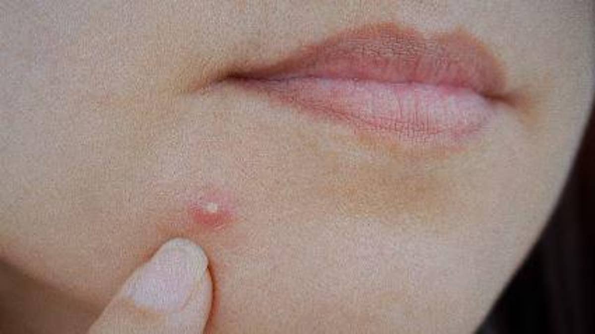 Should you pop a pimple or let it heal on its own? | Fox News