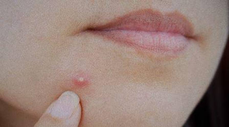 twinkle galdeblæren Konsultere Should you pop a pimple or let it heal on its own? | Fox News