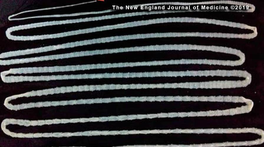 20-foot tapeworm found inside Chinese man鈥檚 intestines