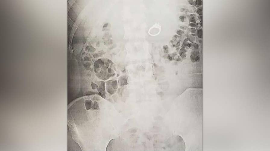 Woman wakes up to find she swallowed her engagement ring in her sleep