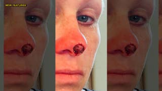 Woman who tanned up to six times a week left with hole in face after skin cancer diagnosis - Fox News