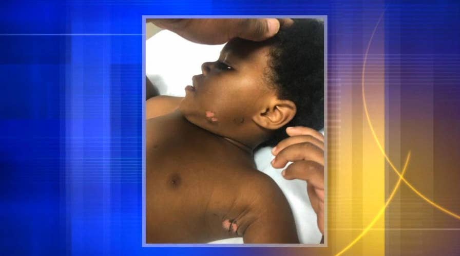 Prosecutors: Man admitted to burning 2-year-old with lighter