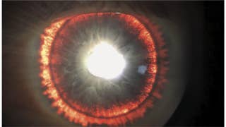Rare syndrome causes man’s eye to 'glow' - Fox News