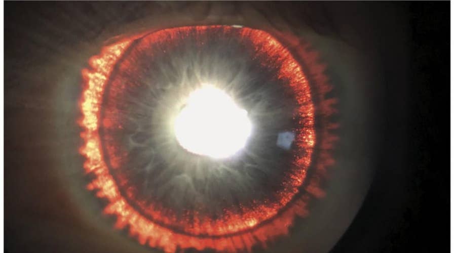 Rare syndrome causes man’s eye to 'glow'