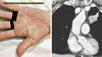 Woman’s 'velvety' palms lead to unsettling diagnosis