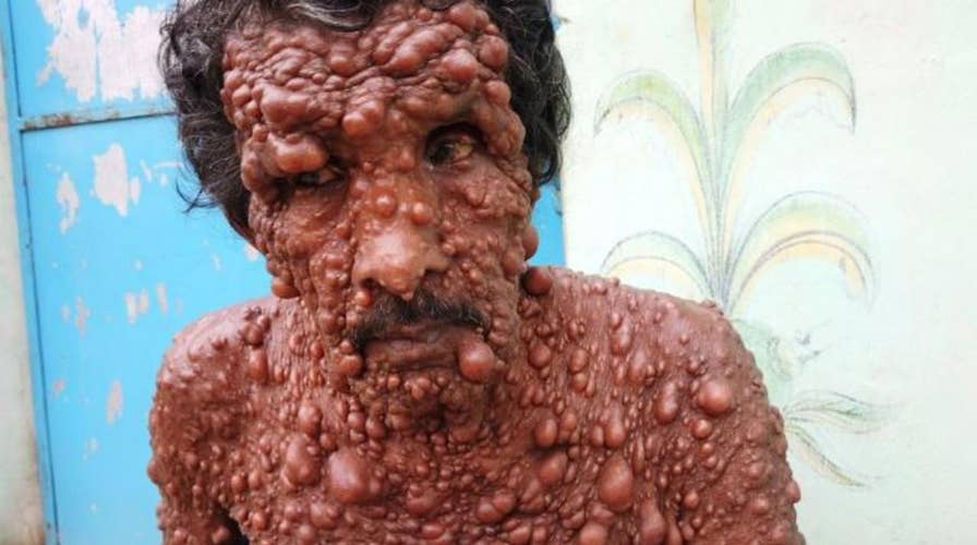 Rare skin condition leaves India man covered in tumors