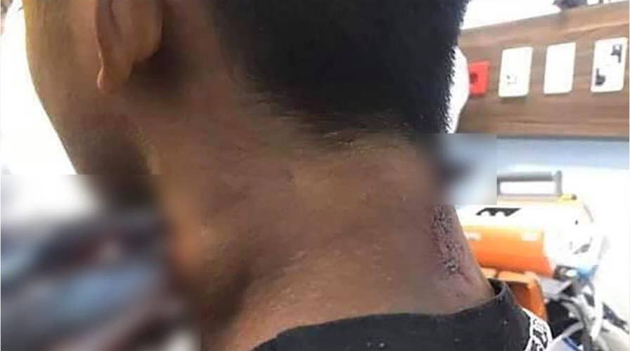 Report: Gruesome photo shows needlefish impaled in teen's neck