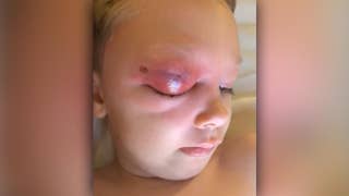 Doctors work to save Florida boy's eye after small cut becomes infected on cruise - Fox News