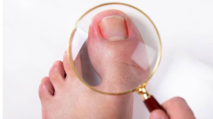 How to spot the signs of an infected toenail