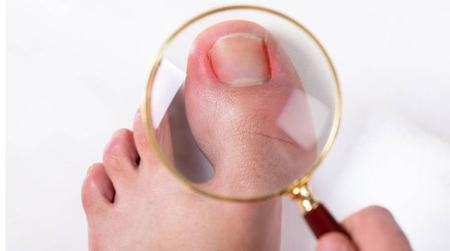 How to spot the signs of an infected toenail