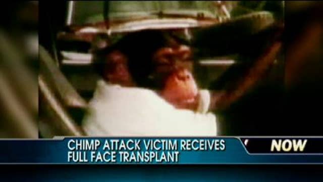woman attacked by chimpanzee face without surgery