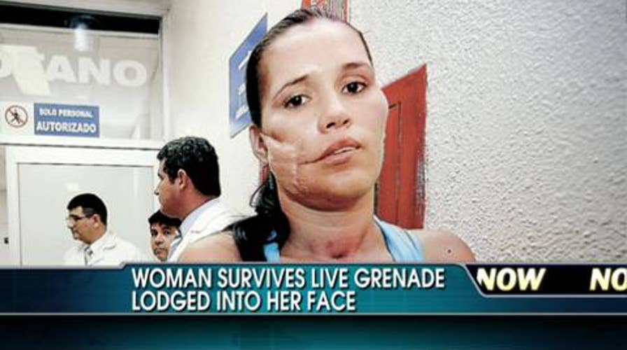 Amazing Story: Mexican Woman Karla Flores Survives After Live Grenade Gets Lodged in Her Face