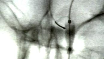 The 411 on sinus surgery