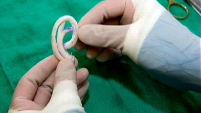 Doctors create new ear for disfigured child