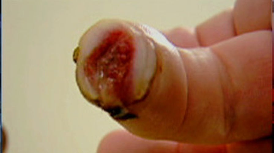 "Pixie Dust" Regrows Severed Finger?