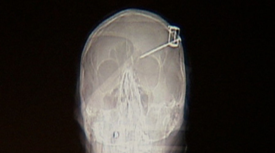 Nail in Skull