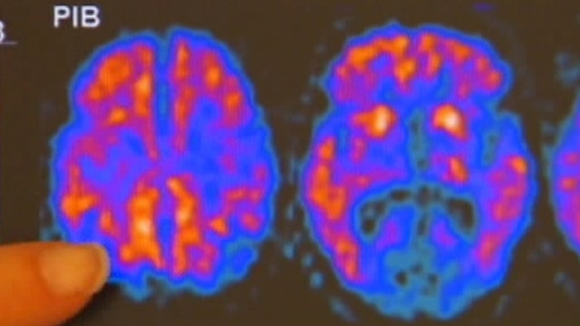 New keys to early detection of Alzheimer's?
