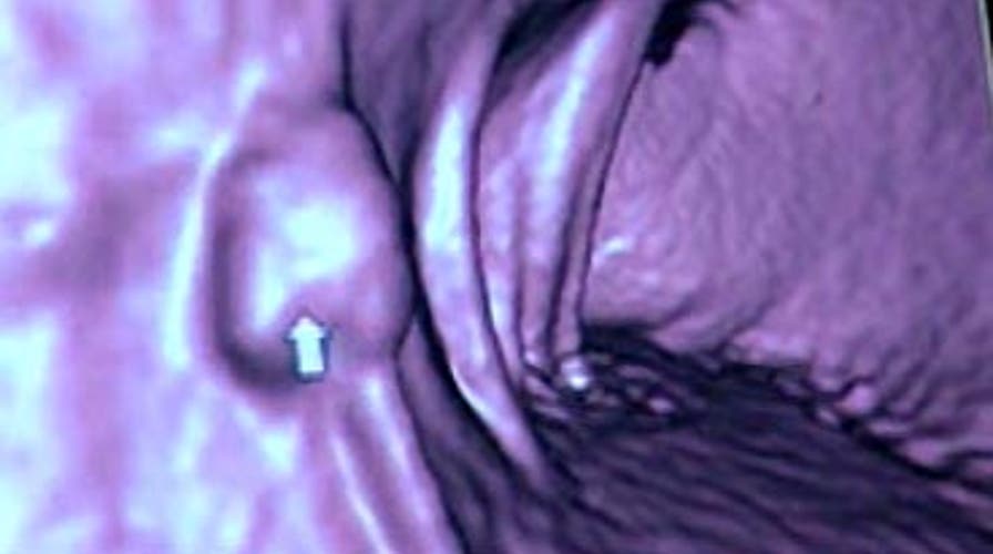 High Tech Colon Screening