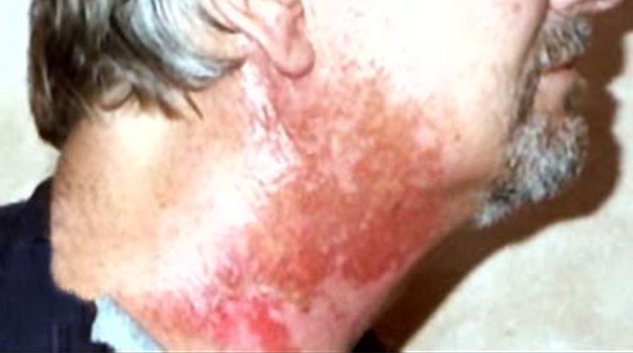 HPV: The Male Factor