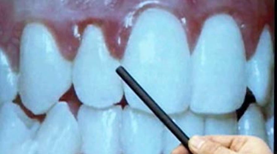 Teeth and Your Heart Health