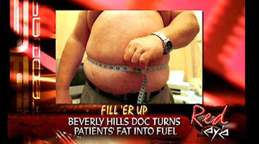 Liposuction Power