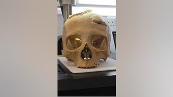 Cancer discovery in ancient SKULL