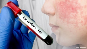 Contagious childhood disease on the rise among all age groups - Fox News