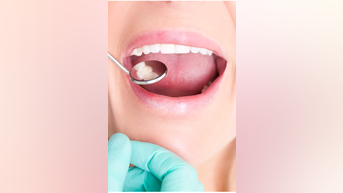 Most common causes of CAVITIES - Fox News