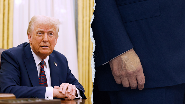 White House releases Trump health update after speculation over swollen legs, bruised hands - Fox News