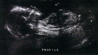 14-year-olds recruited for 'abortion doula' training at North Carolina university event - Fox News