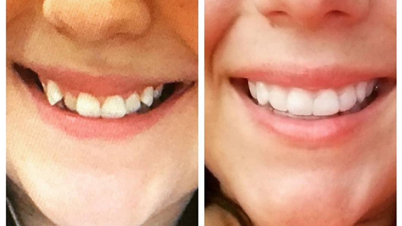 Does Smile Direct Accept Insurance Smile Direct Club