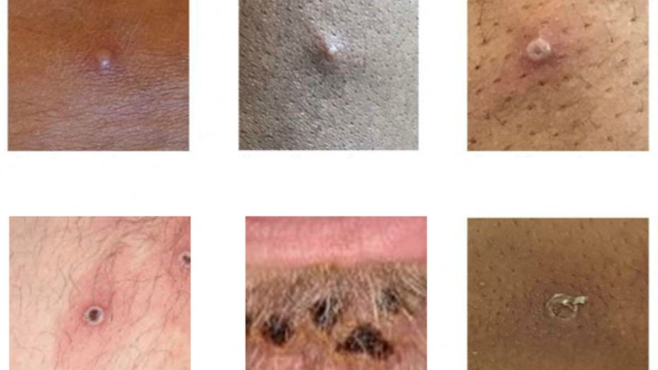 Monkeypox symptoms