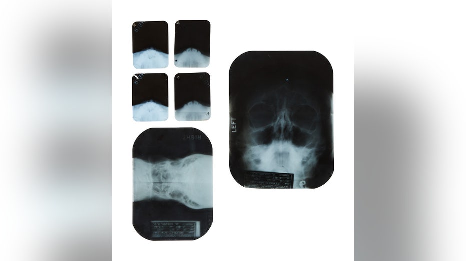 Marilyn Monroe's X-rays