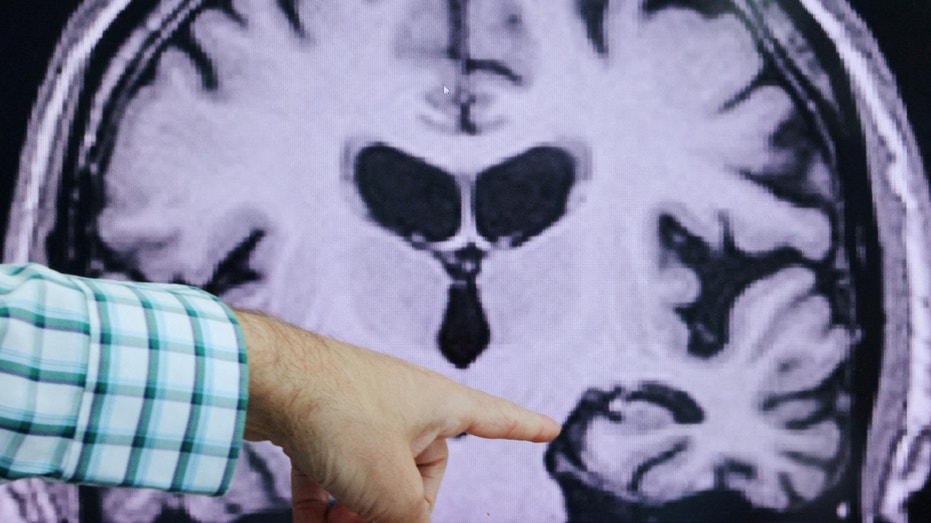 Alzheimer's disease MRI brain scan