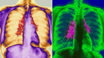 How old are you? Scientists find way to work out age by studying chest X-rays