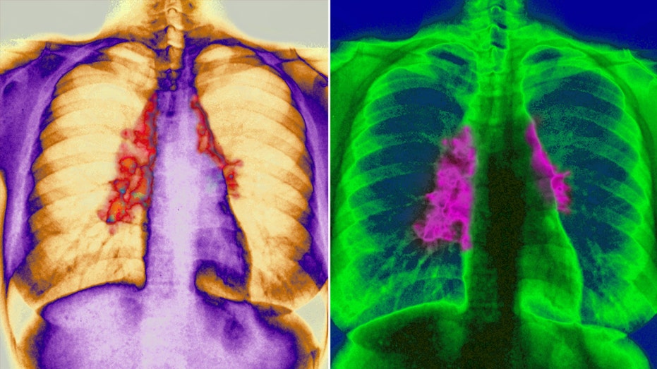 chest x-ray