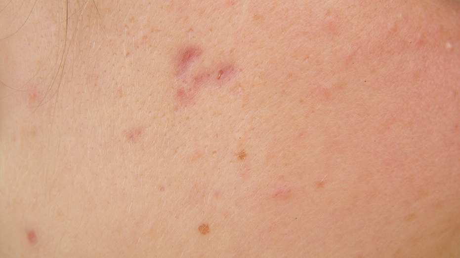 Acne scarring