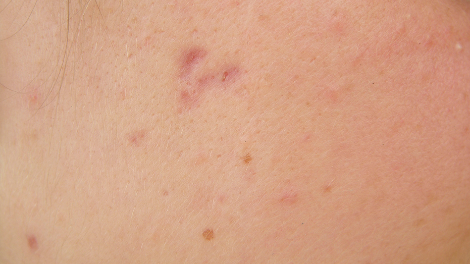 Acne scarring