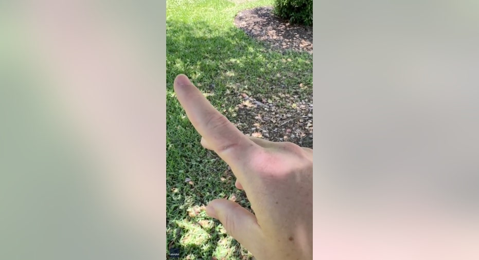 Damaged pointer finger