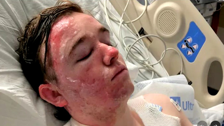 Jacob Smith lying in hospital bed with severe burns