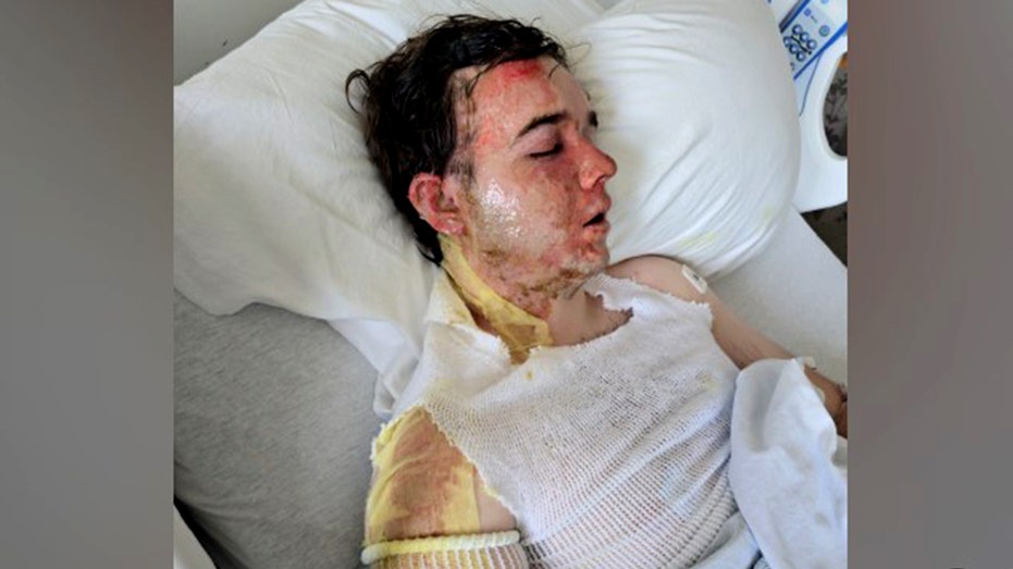 Jacob Smith lying in hospital bed with severe burns