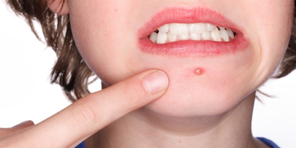 Как выглядит коксаки на лице Why some people get zits and others don't Fox News