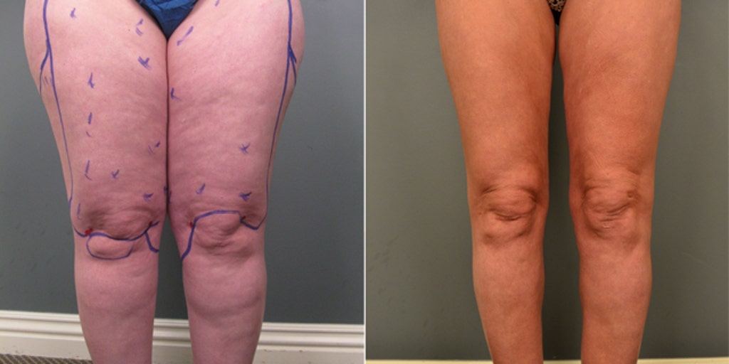 Liposuction: A surprising treatment for a painful condition
